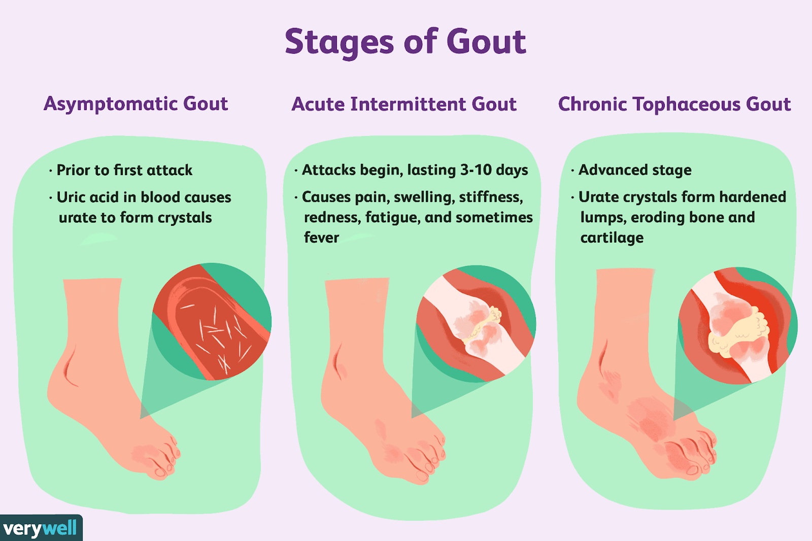 Understanding the Sting A Guide to Ankle Gout Leedsjournal