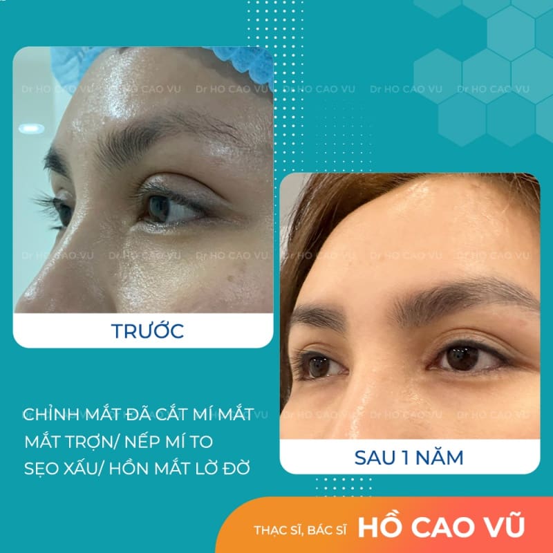 Tất tần tật những điều cần biết về phương pháp cắt mí Hàn Quốc 