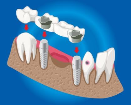 Dental Bridge