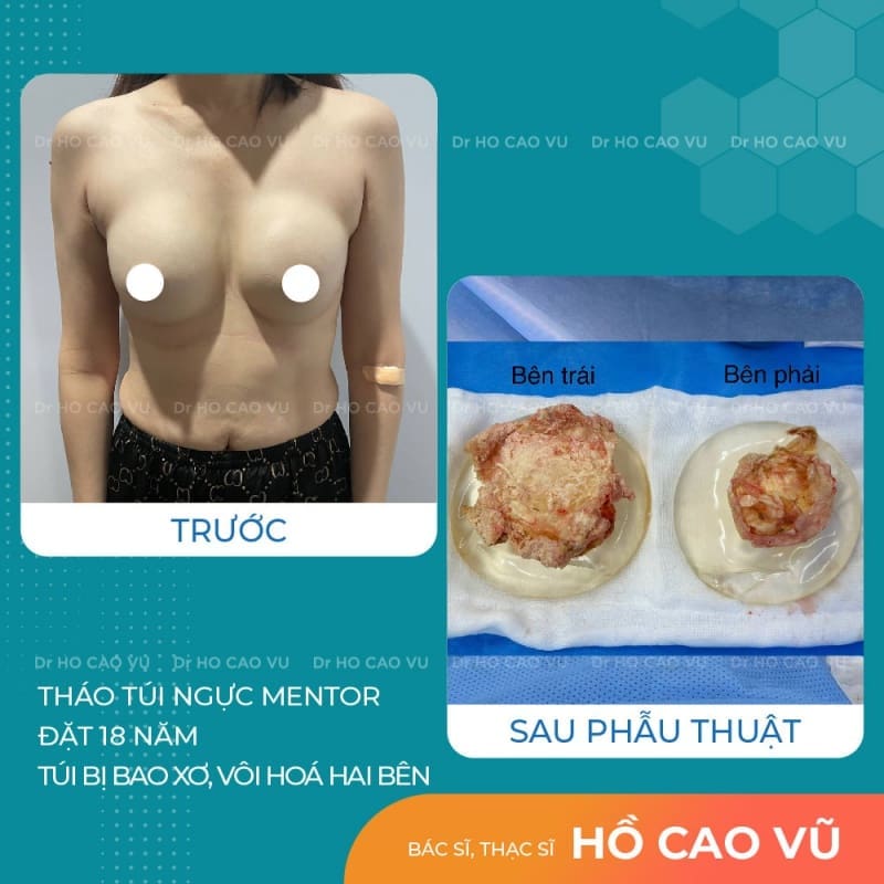 Nhìn lại toàn cảnh ca phẫu thuật tháo túi Mentor đặt hơn 18 năm cho chị khách U50