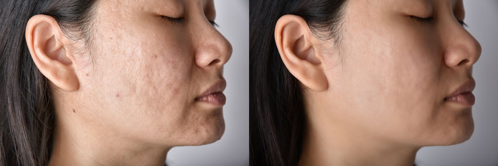 before and after acne treatment