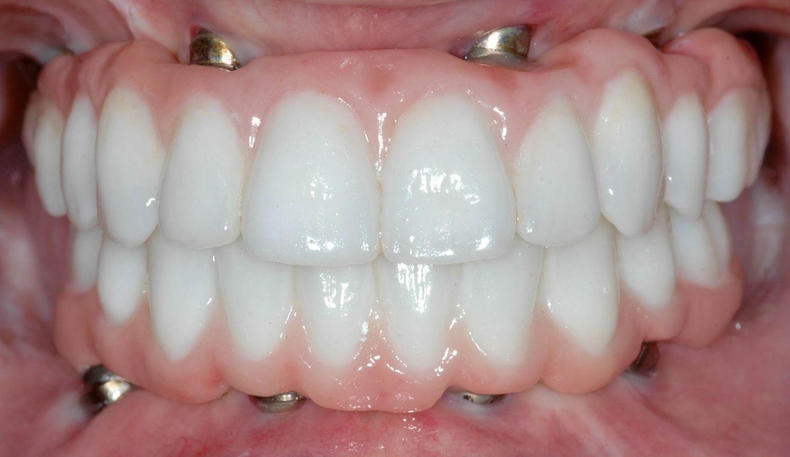 Upper and Lower Implant Bridges