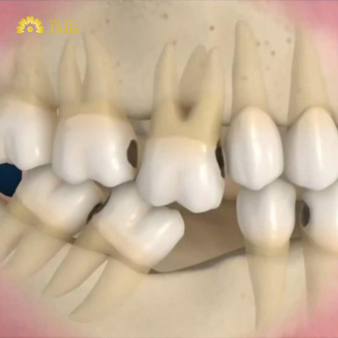 Cầu răng sứ giúp giữ cho các răng kế cận ổn định