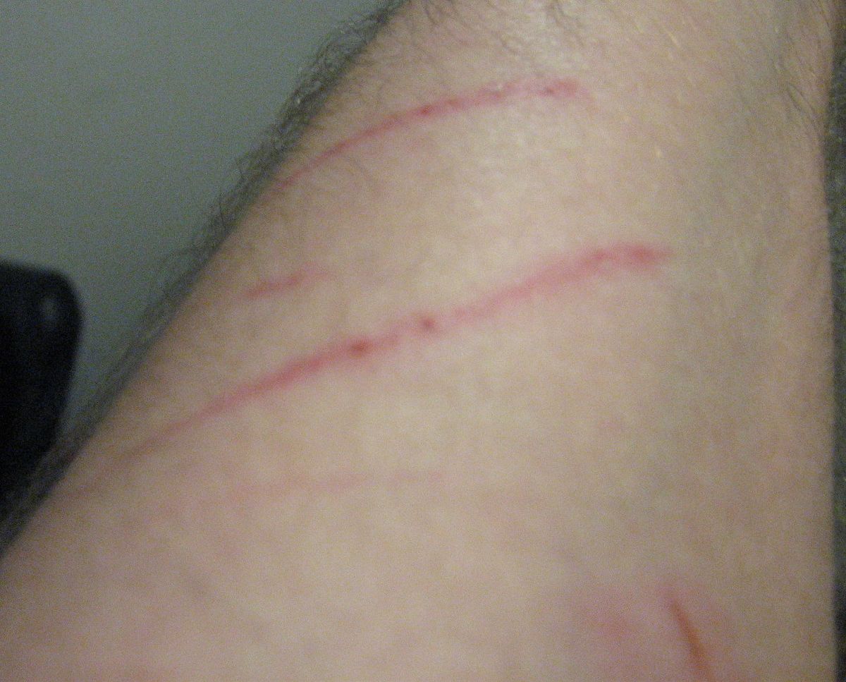 Practical Steps to Take After Experiencing a Dog Bite Dream