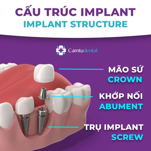 Cấu trúc của một trụ Implant bao gồm mão sứ, khớp nối và thân trụ implant