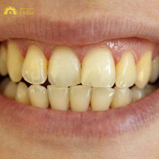 Trào ngược dạ dày là bệnh lý hàng đầu khiến cho men răng dần trở nên yếu đi