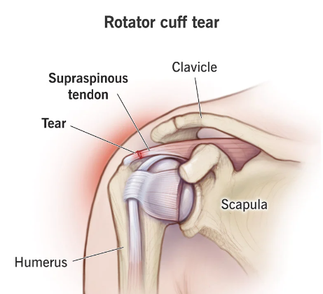  Rotator Cuff Injuries
