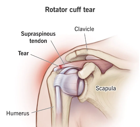 Rotator Cuff Injury Program at Synergy Health and Wellness