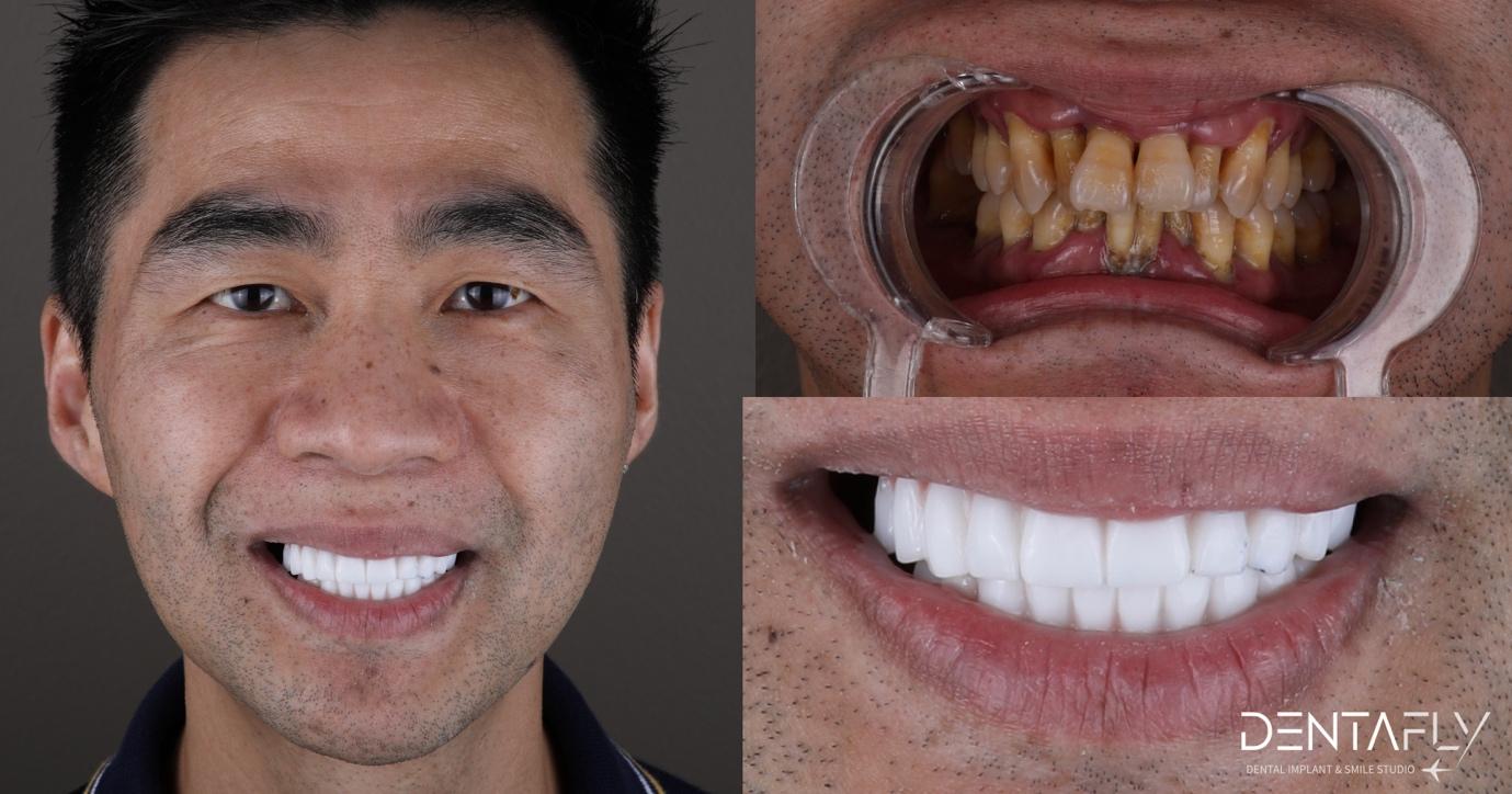 A close-up of a person's teeth

Description automatically generated