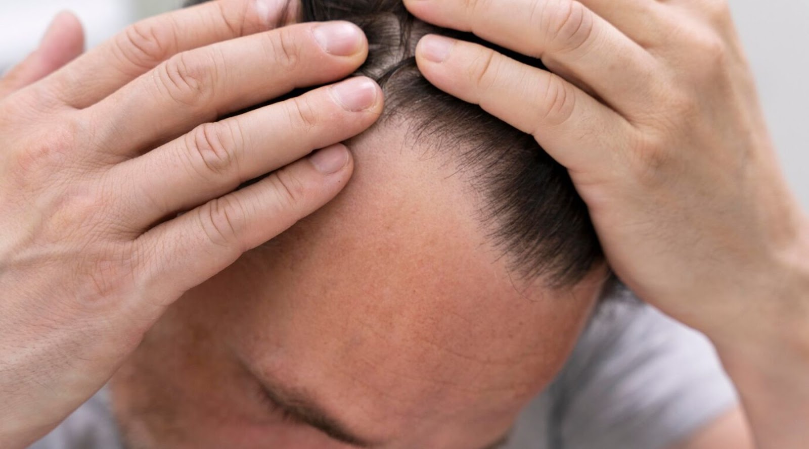 Understanding Hair Loss