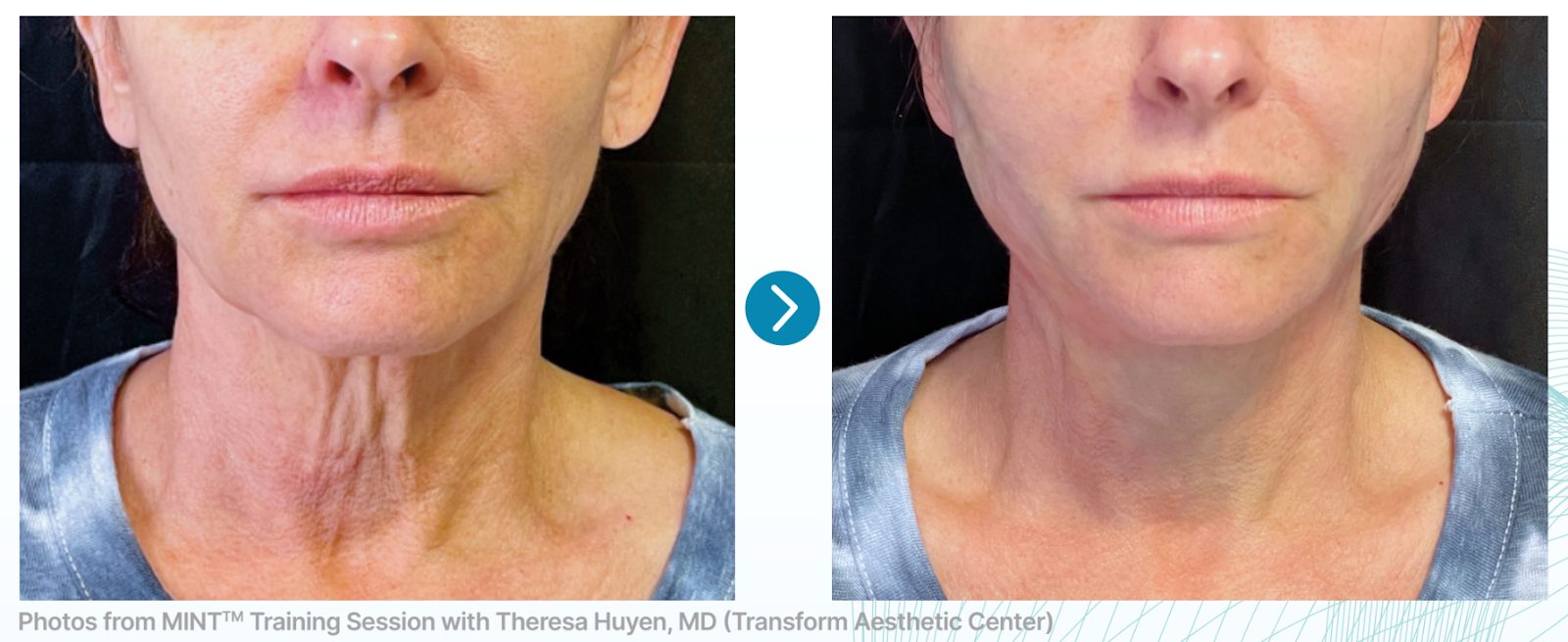 female male neck before and after using MInt PDO Thread Lift
