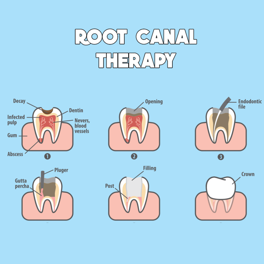 Root Canal Therapy