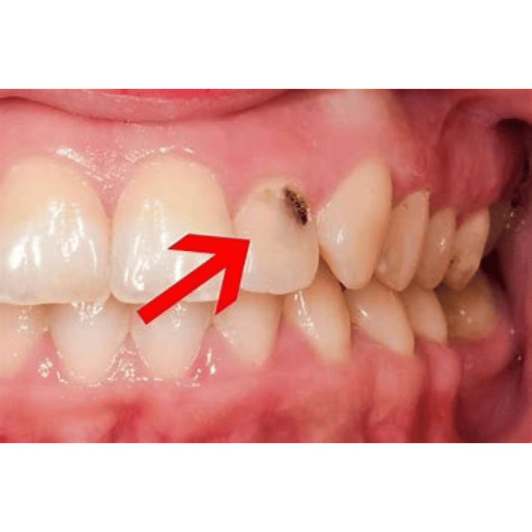 Cavity on Side of Tooth