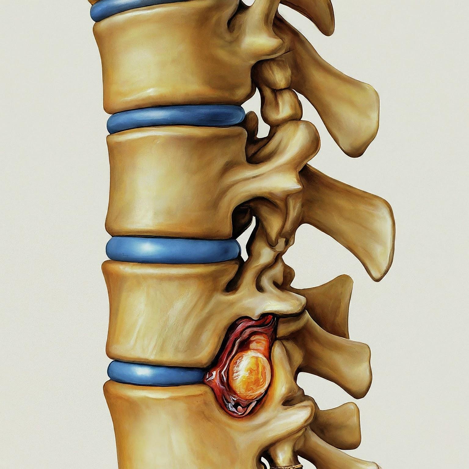 Herniated Disc Injury attorney in Lancaster