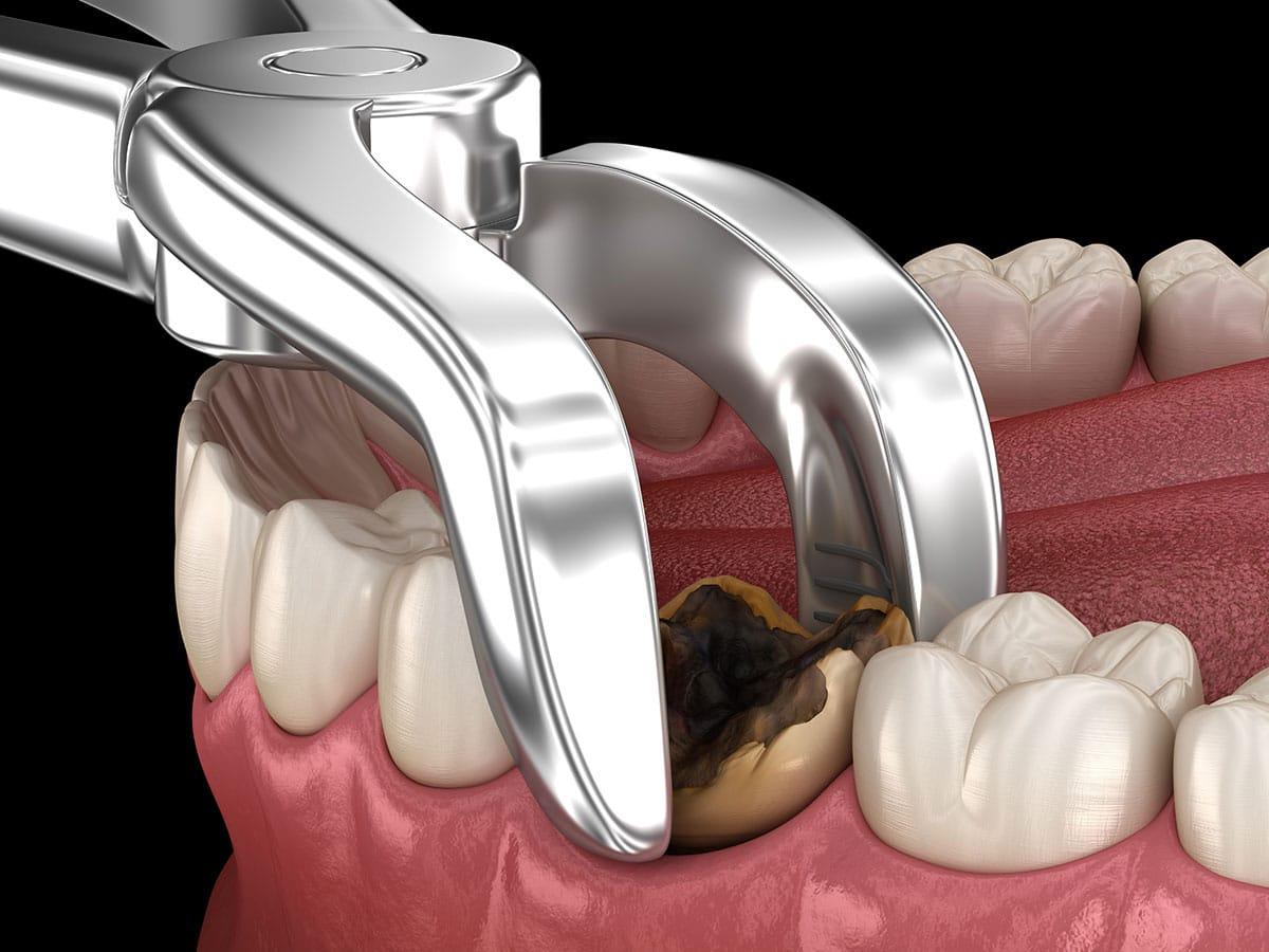 wisdom tooth removal in Scarborough 