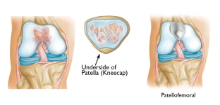 Kneecap replacement (patellofemoral arthroplasty - PFA)