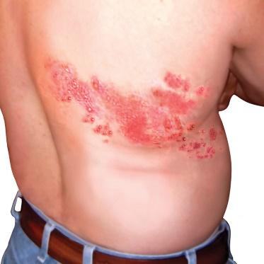 A person with a rash on their back

Description automatically generated