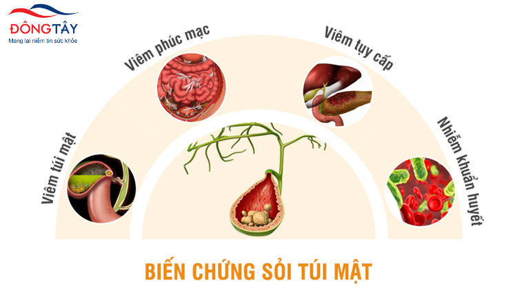 Sỏi mật và những biến chứng khó lường