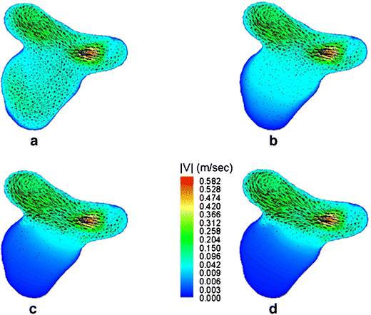 Haemodynamic simulation of aneurysm coiling in an anatomically accurate  computational fluid dynamics model: technical note | Neuroradiology