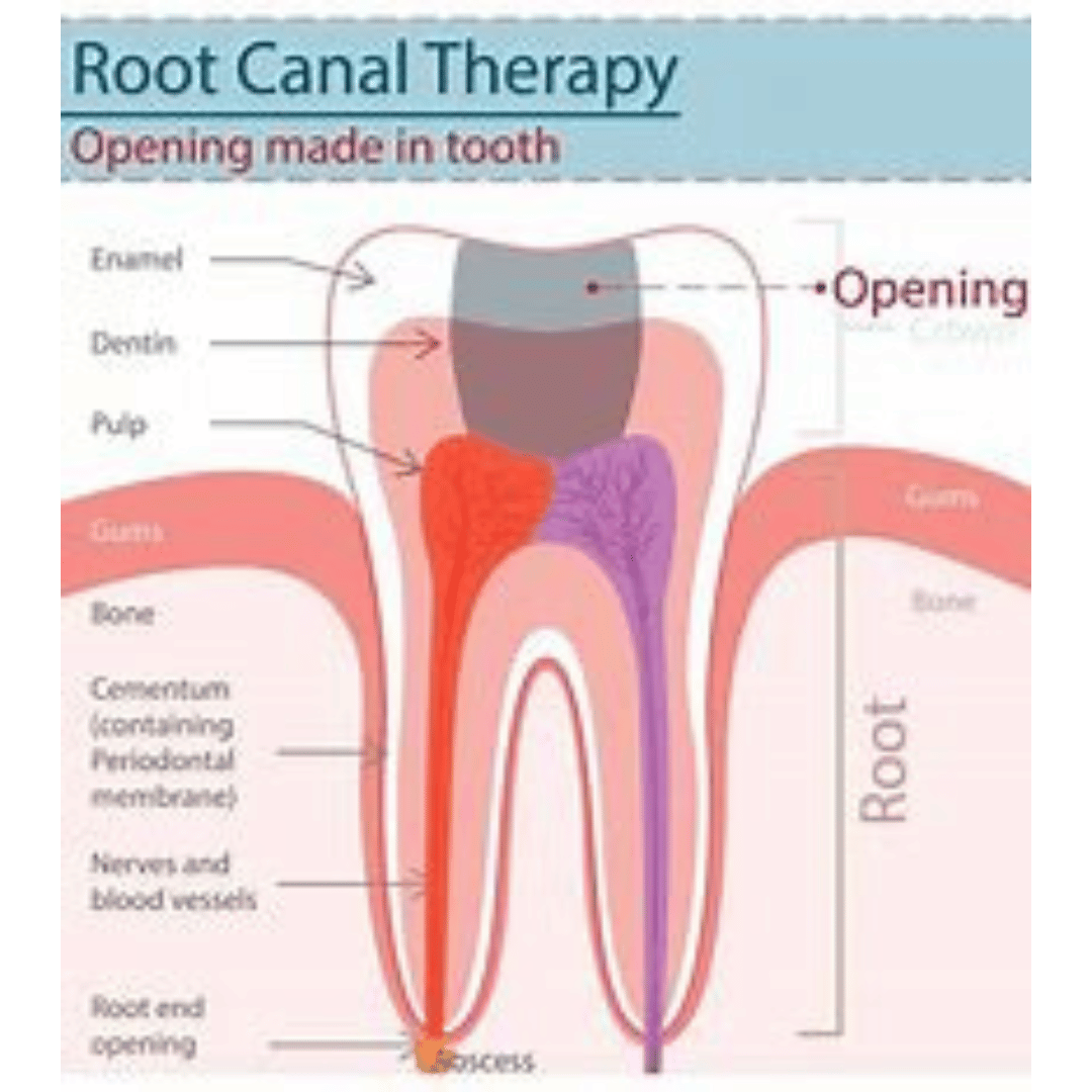 Root Canal Therapy