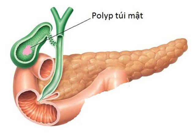 Điều trị polyp túi mật cần dựa vào tình trạng bệnh cụ thể và kích thước polyp