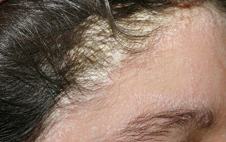 Nấm da đầu là bệnh gì?