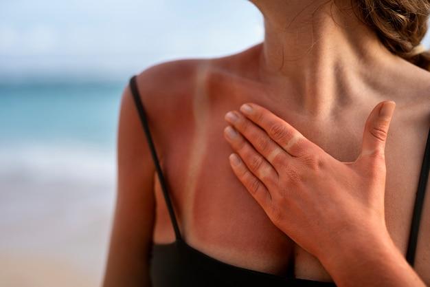 Details of a woman's sunburn skin from the beach sun