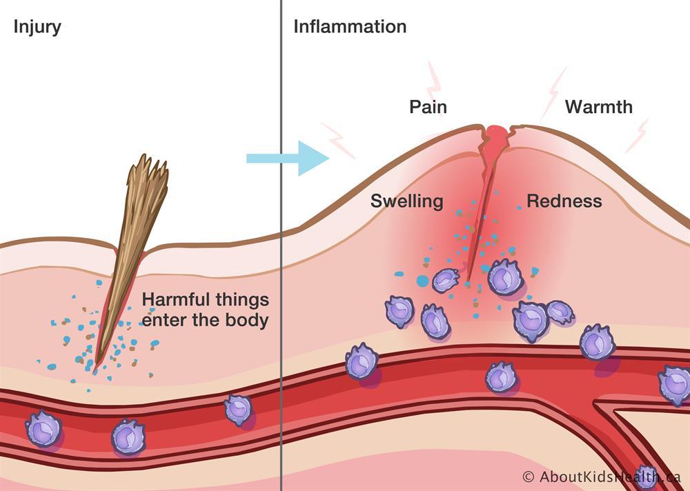 Inflammation and auto-inflammation