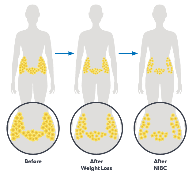 Infographic comparing fat cell size and quantity before and after weight loss and CoolSculpting treatments.