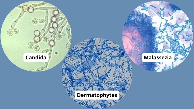 Các loại nấm thường hay gây bệnh ngoài da nhất