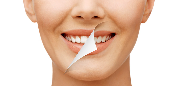 teeth whitening services in Richmond Hill 