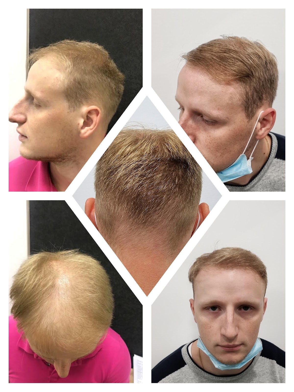 Foto%2013.%20FUE%20before%20and%20after%202000%20grafts%20transplant%20