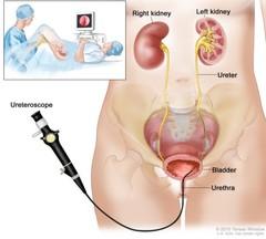 \\sghfslogix\UserData\sghd02800\Desktop\flexible ureteroscope.jpg