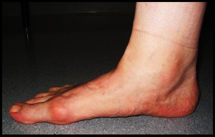 http://www.stvincentpodiatry.org/Adult_Acquired_Flatfoot_files/slide0003_image008.jpg