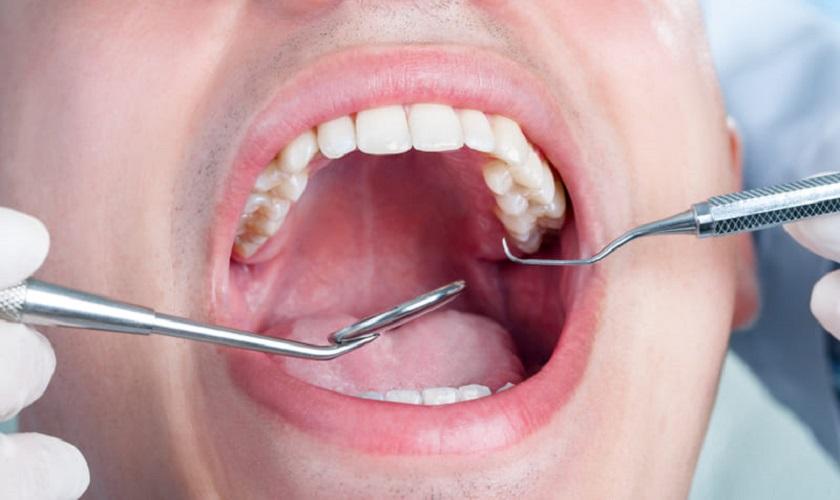 Bọc răng sứ hàm trên có tốt không?
