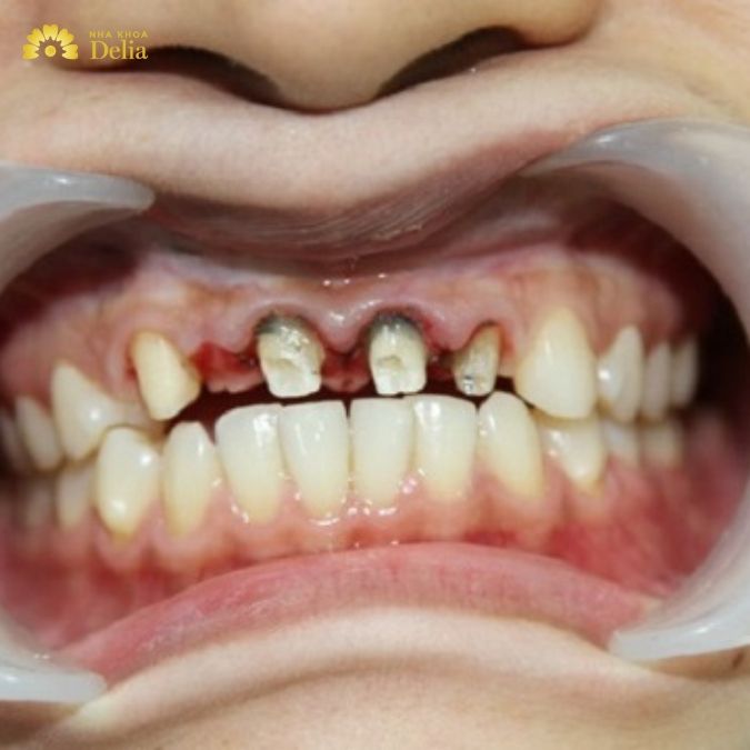 Răng sứ Trung Quốc là gì?