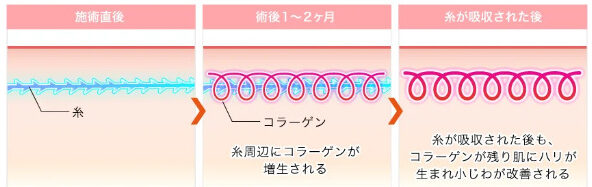 糸リフトの仕組み。TCB東京中央美容外科より引用。