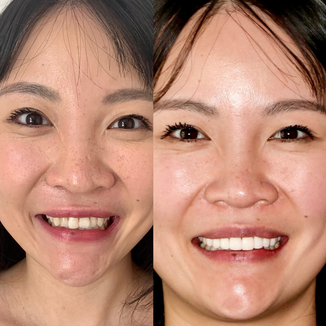 Blepharoplasty Before and After: Stunning Transformations