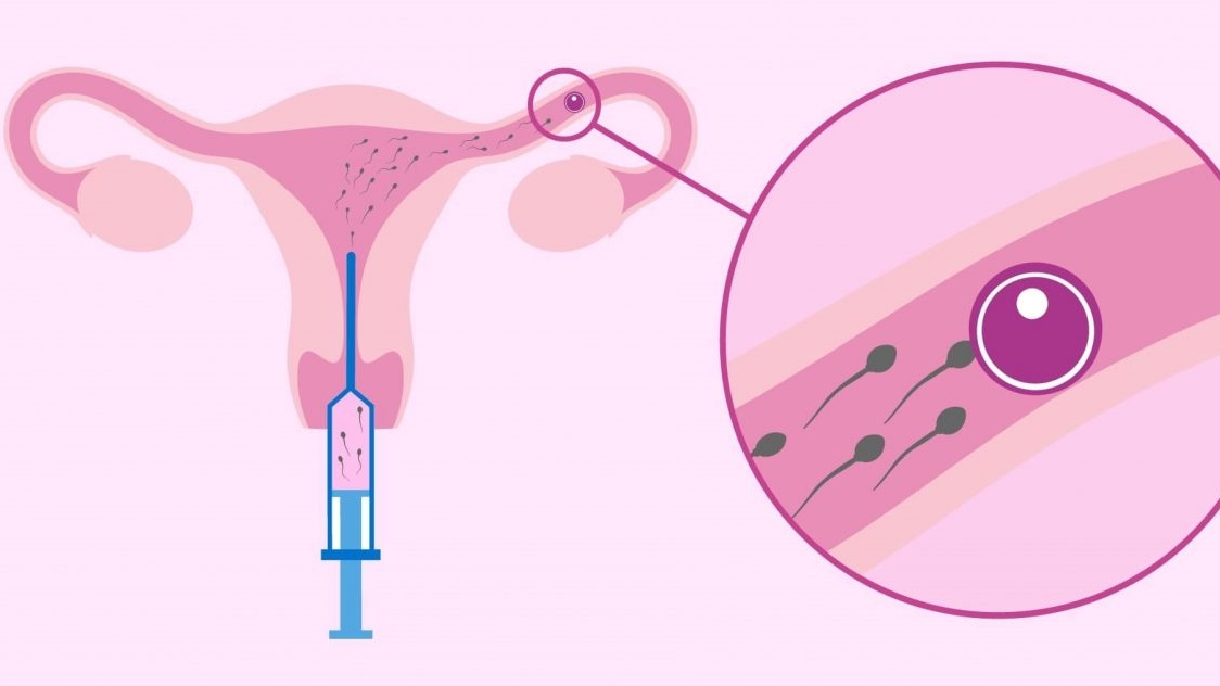 Quy trình tiêm thuốc kích trứng IUI và những điều cần biết 2