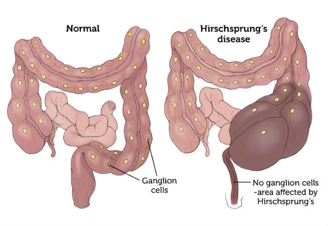 Hirschsprung's Disease | Boston Children's Hospital