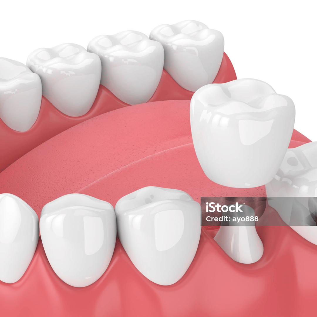 how often do dental crowns need to be replaced