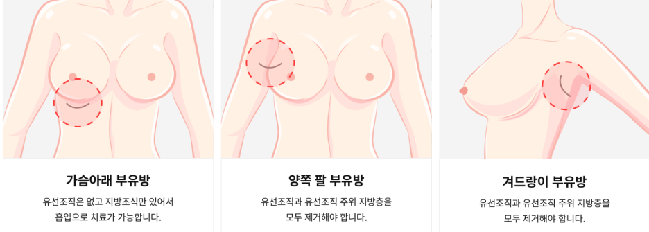 부유방종류.png