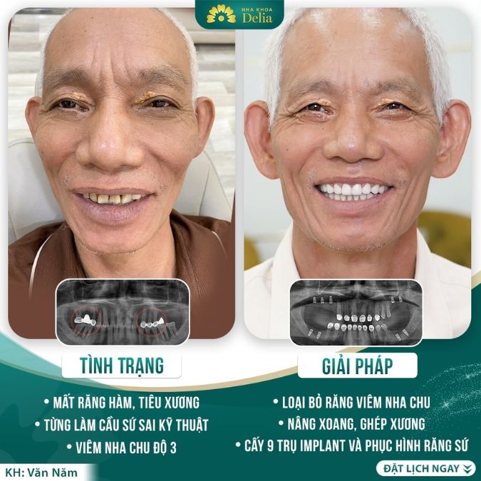 Trồng răng implant cho người già có được không? Nên hay không?