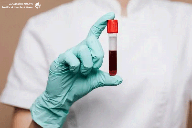 آزمایش خون برای تشخیص کبد چرب