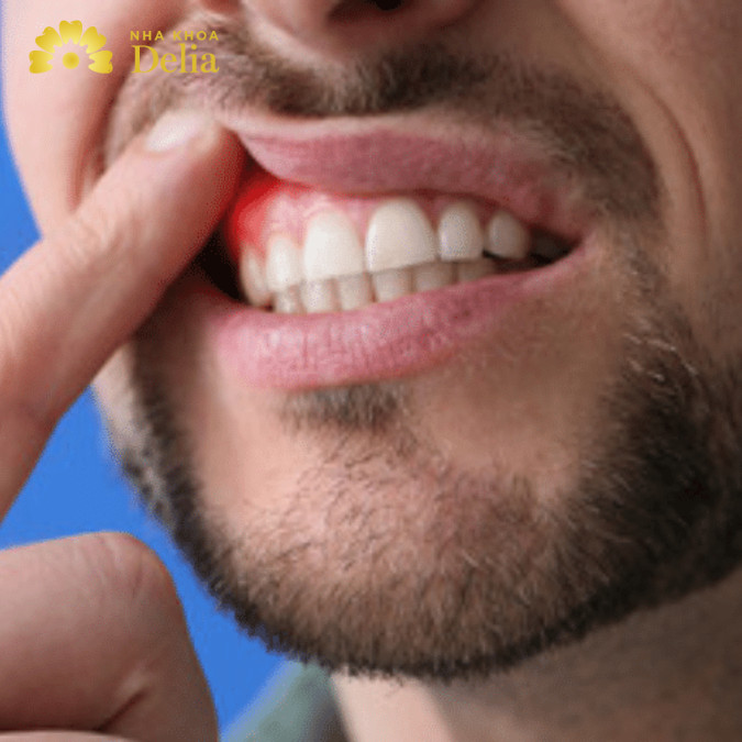Nguyên nhân do viêm nướu dẫn đến chảy  chân răng khi ngủ 