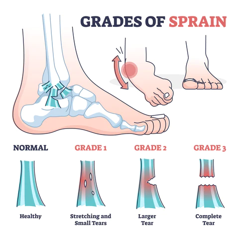 grades-of-sprain