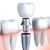 Giá Trồng Răng Implant