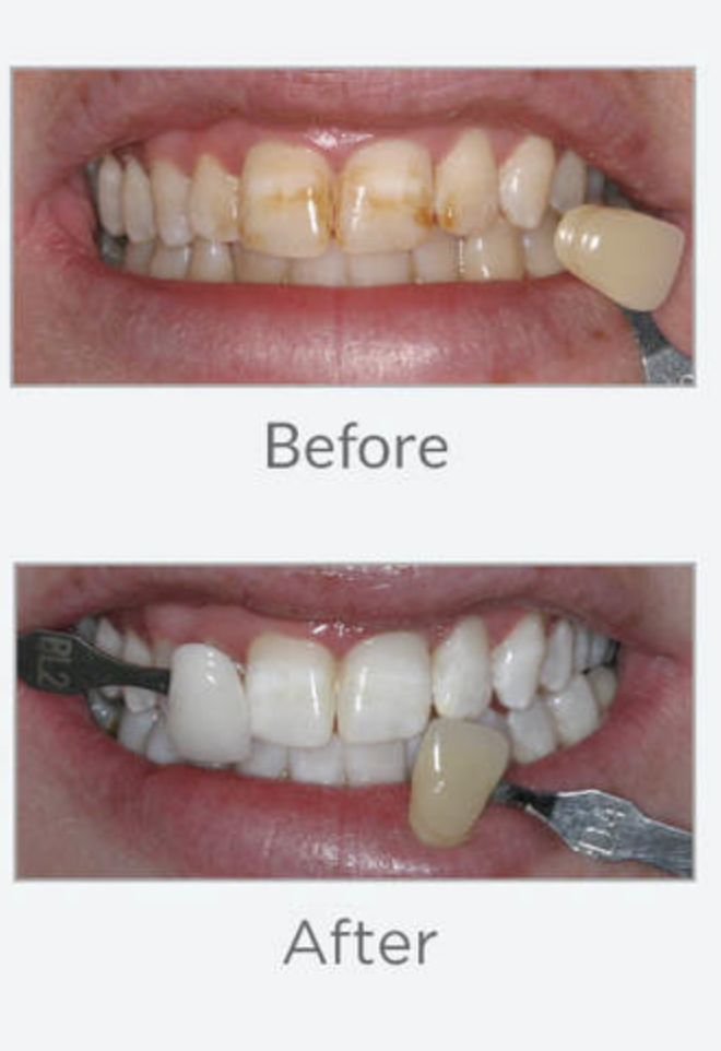 DIscoloured older looking teeth before and after whitening 