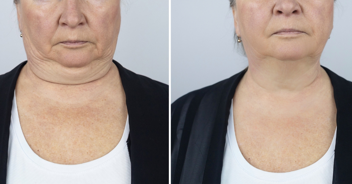 How Much Neck Liposuction Cost Liposuction
