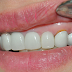 Cách xử lý khi răng sứ bị hở chân răng hiệu quả